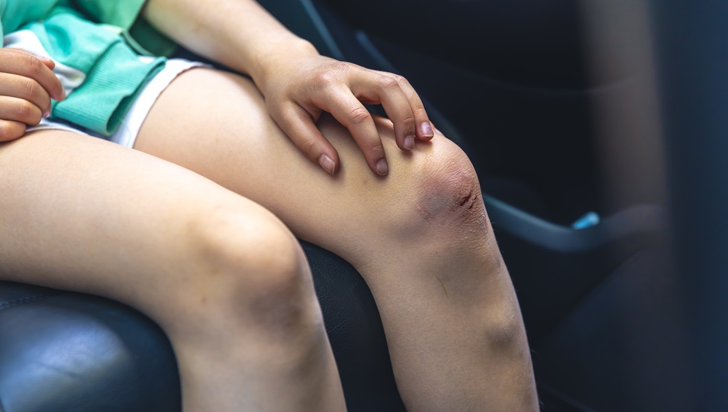 Close-up of little girl holding her bruised injured damaged knee with her hands.